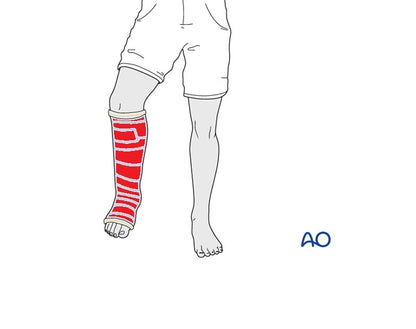 Waterproof Cast Cover for Child Leg - Size 2 (CL2)