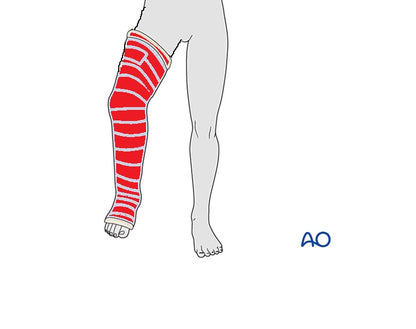 Waterproof Cast Cover for Child Leg - Size 3 (CL3)