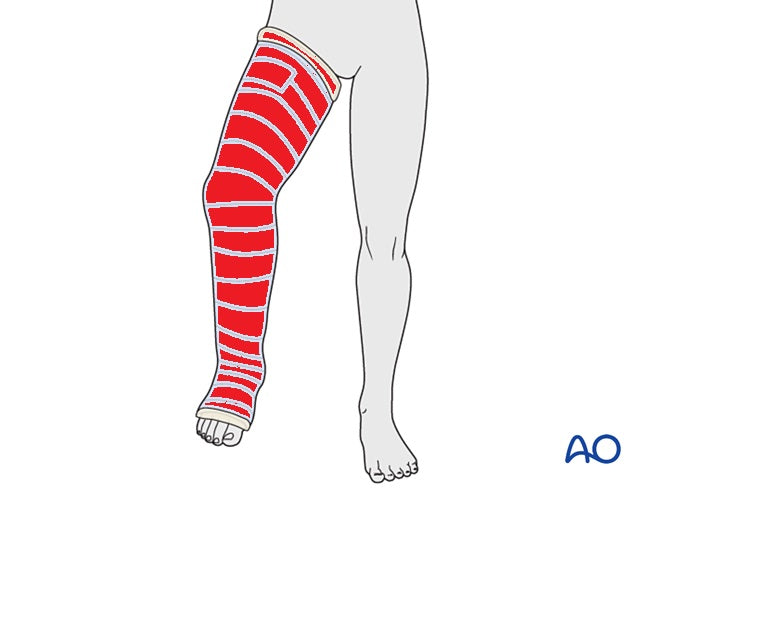 Waterproof Cast Cover for Child Leg - Size 4 (CL4)